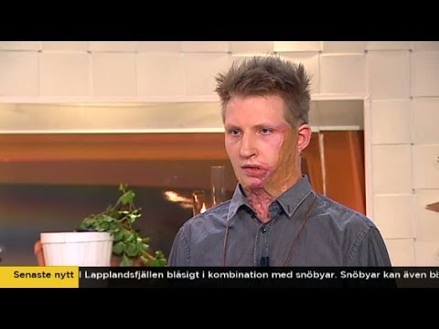 Brännskadade Axel om tågsurfningen som nästan tog hans liv - Nyhetsmorgon (TV4)
