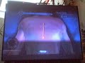 trauma center: new blood run of operation 2-4 stigma.
xs rank using valerie with a final operation score of 6444.

check out my channel for more trauma center: new blood videos.