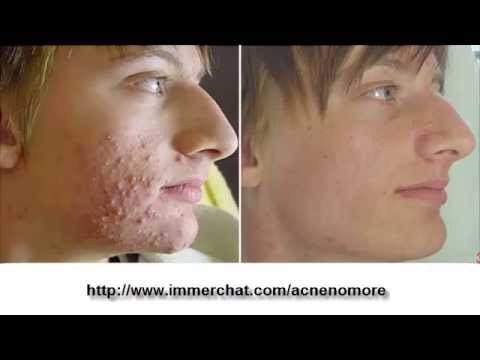 how to prevent acne n pimples