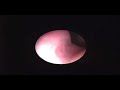 Nasal Endoscopy