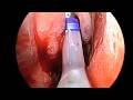 Lumina Light Cable - Device for Frontal Balloon Sinuplasty Lumina Light Cable - Device for Frontal Balloon Sinuplasty