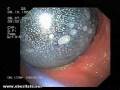 Interventie balon intragastric - by Dr. Niculae Iordache