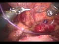 Robotic Partial Kidney Removal – Ischemia Reducion Due To Early Unclamping Method Application Robotic Partial Kidney Removal – Ischemia Reducion Due To Early Unclamping Method Application
