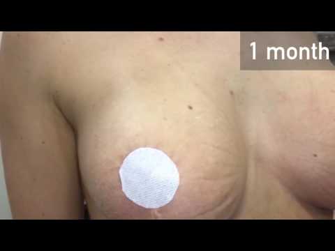 Подтяжка груди на имплантах. Результат через месяц