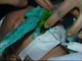 Complete cleft lip&palat cases, Facial impression