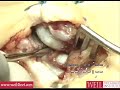 Weil Decompression Osteotomy for Hallux Rigidus Weil Decompression Osteotomy for Hallux Rigidus