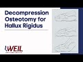 Weil Decompression Osteotomy for Hallux Rigidus | Weil Foot & Ankle Institute