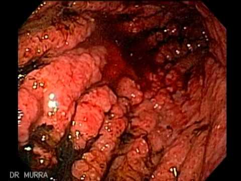 como perder la grasa dela barriga en una semana como perder la grasa dela barriga en una semana
