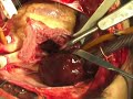 Removal of RA Myxoma on beating heart 2