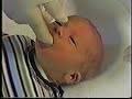 Frenotomy Assessment