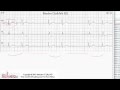 ECG Interpretation, Basic Level - Part 2 ECG Interpretation, Basic Level - Part 2
