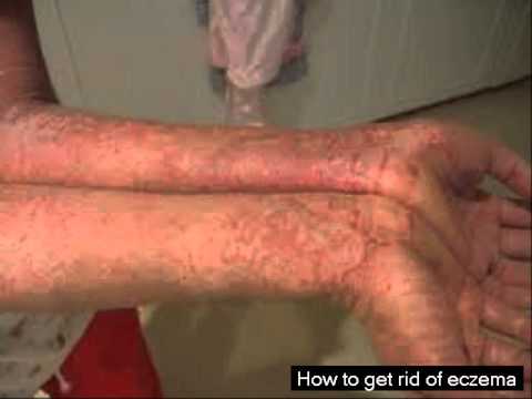 how to reduce eczema redness