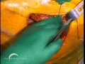 Birmingham Hip Resurfacing (BHR) by Derek McMinn Part 5