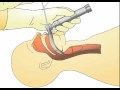 Tracheal Intubation