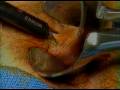 Hemorrhoidectomy Procedure