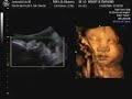 Ultrasound of Baby in 4D Ultrasound of Baby in 4D