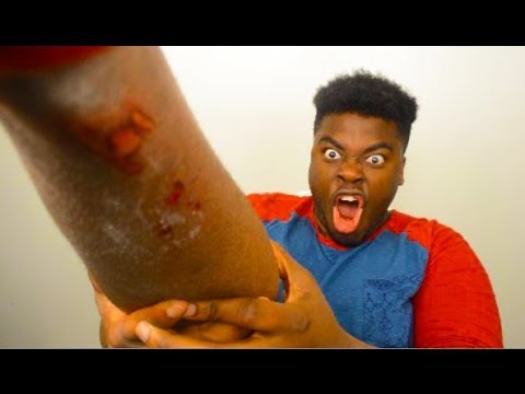 Bike Accident AfterMath! Lemon On Wound (Warning)