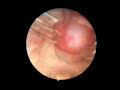 Prof. Dr. Mete Düren - Tiroid Ameliyatı