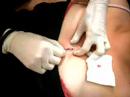Micro dermal par Morgane
