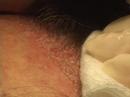 Dallas hair transplant:  graft placement video 1