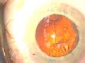 Stop and Chop Cataract Surgery Stop and Chop Cataract Surgery
