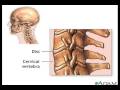 Cervical Spondylosis