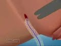 Minimally Invasive Surgery Corrects Urinary Incontinence