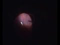 Sutureless vitrectomy for retinal detachment