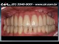 Protocolo superior é o nome dado a técnica que substitui todos dentes na arcada superior através de implantes dentários. O implante dental é um pequeno cilindro confeccionado em titânio puro, com roscas externas semelhante a um parafuso. O titânio adere ao tecido ósseo, produzindo uma ligação biológica entre o osso eo titânio, conhecida como osseointegração.