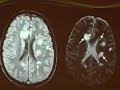 MRI of Multiple Sclerosis