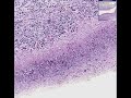 Histopathology Colon, esophagus --Candidiasis