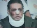 fabian lavalle con el rostro golpeado