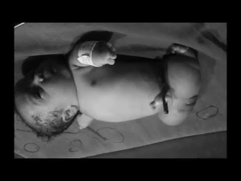 phocomelia - Teratogenicity phocomelia micromelia Condition in a new born baby
