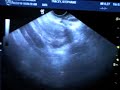 8 weeks 3 days first ultrasound
