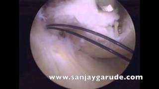 Arthroscopic PCL reconstruction