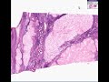 Histopathology Ovary-corpus albicans--Normal-corpus albicans
