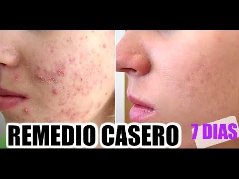 Mascarilla casera para el acne