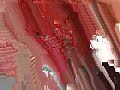dentaImplant Standard Plus Implant surgery straumann. dentaImplant Standard Plus Implant surgery straumann.