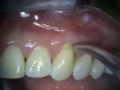 Periodontal Microsurgery: AlloDerm Grafting
