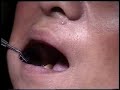 UVB Reynosa - Enfermedad Periodontal UVB Reynosa - Enfermedad Periodontal