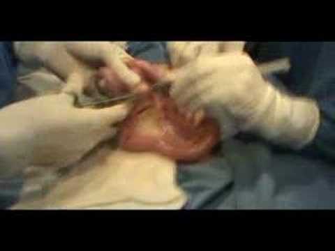 Anastomosis - Entero-Entero Anastomosis Término-Terminal Realizada En Canino -- Video & Audio -- - Edited By Risck -