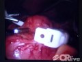 Lap-Band Minimally Invasive Surgery For Weight Loss