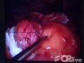 Lap-Band Minimally Invasive Surgery For Weight Loss