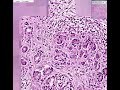 Histopathology Pancreas--Adenocarcinoma