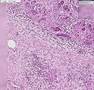 Histopathology Pancreas--Adenocarcinoma