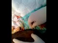 popping a zit (abscess)