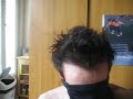 Greffe de cheveux dr Rahal 8.5 mois post op cheveux sales