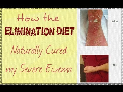 how to help eczema