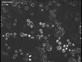 Treating breast cancer cells with taxol  Cancer Docetaxel