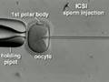 IVF & ICSI brief overview